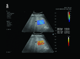 Liver ultrasound markers