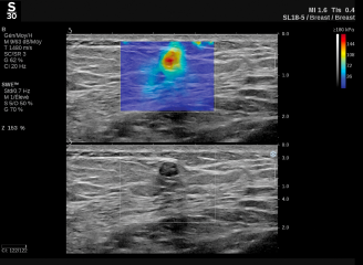 ShearWave™ PLUS elastography