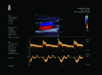 UltraFast Doppler