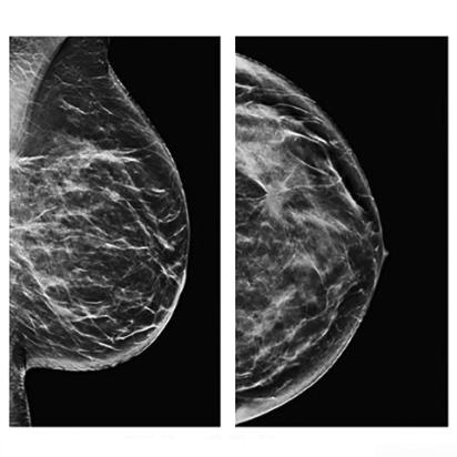Breast Image Analytics