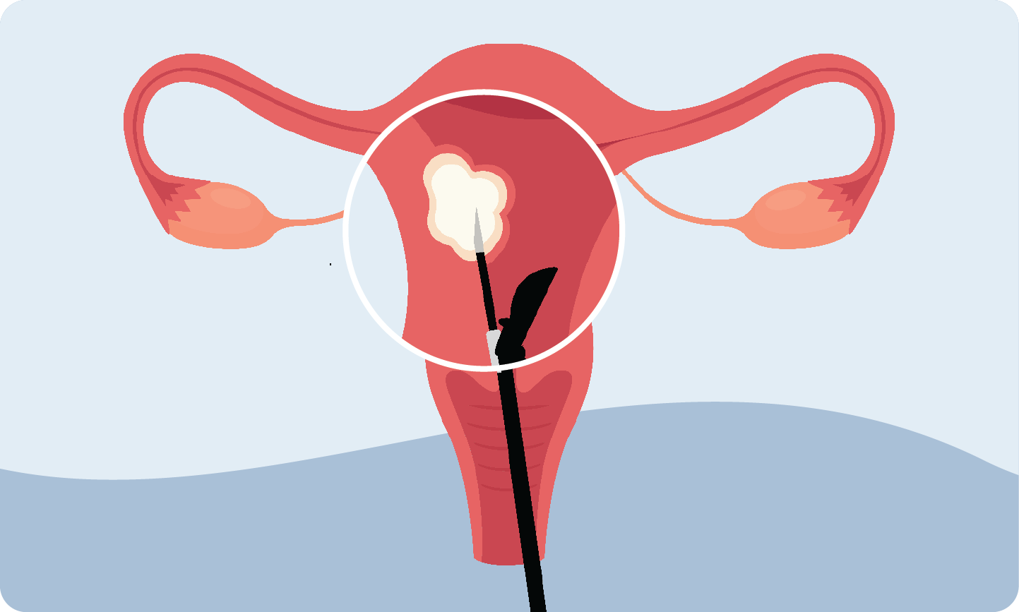 Illustration of the uterus, showing how the medical procedure shrinks the fibroid.