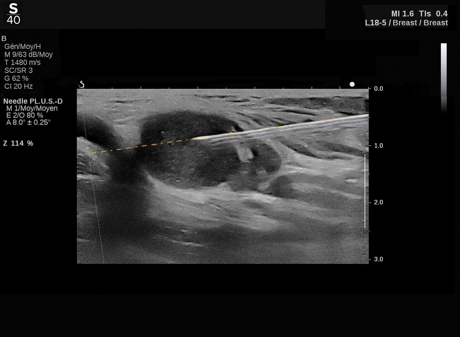 Hologic Needle PLUS™ clinical image