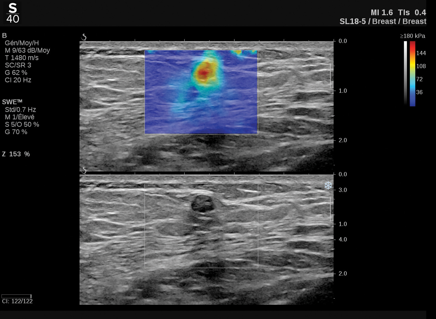 Hologic ShearWave™ PLUS elastography clinical image