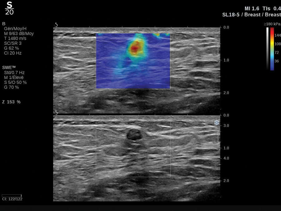 Hologic ShearWave™ PLUS elastography clinical image