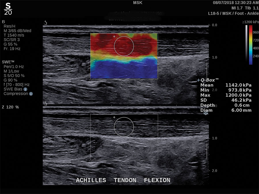 Hologic ShearWave™ PLUS elastography clinical image