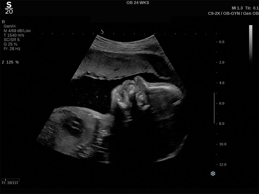 Hologic 3D clinical image