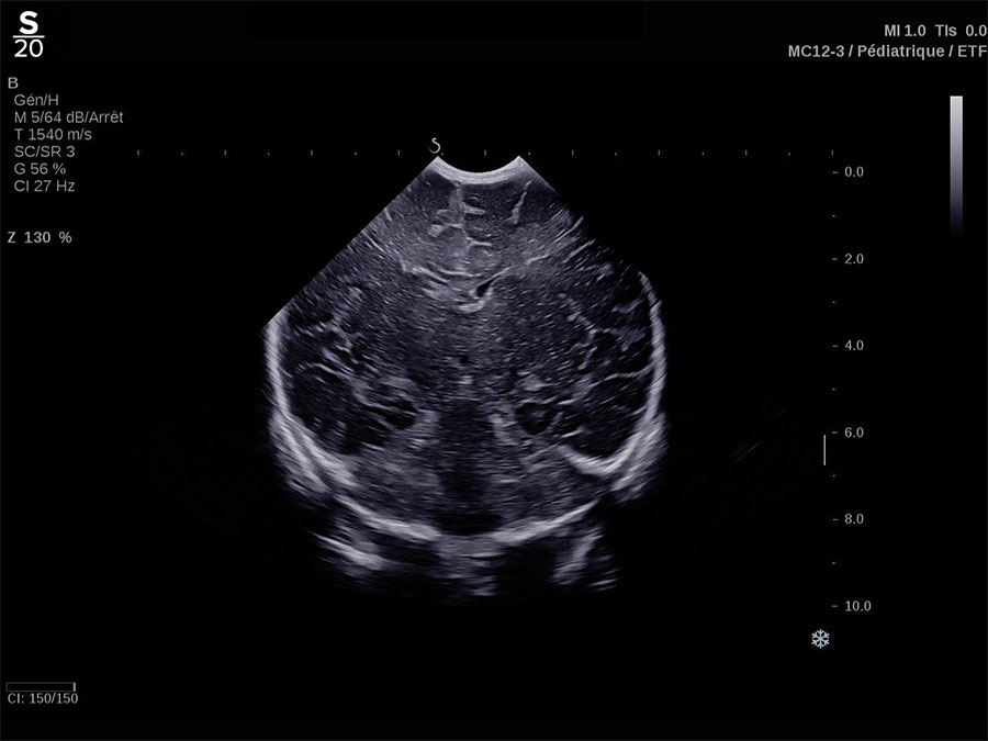 Hologic Needle PLUS™ clinical image