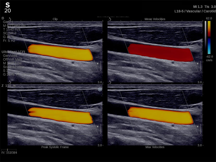 Hologic ShearWave™ PLUS elastography clinical image