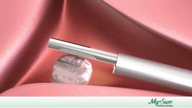 Embedded thumbnail for MyoSure Procedure Animation