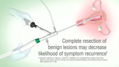 Embedded thumbnail for MyoSure REACH
