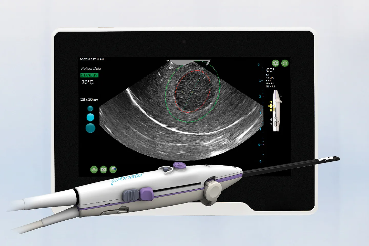 Sonata® Transcervical Fibroid Ablation System