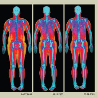 Hologic Horizon - body-composition